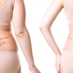 What happens to a tattoo when you lose weight