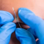 Does a eyebrow piercing hurt