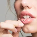 How to stop lip piercing embedding