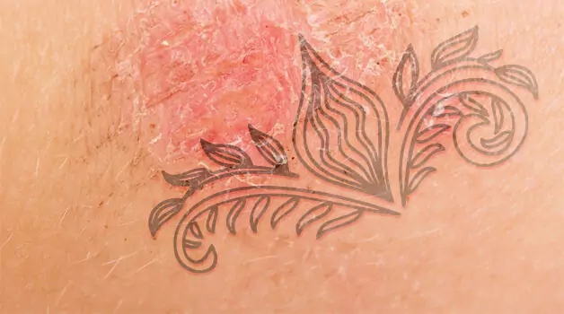 Issues You May Face If Tattoo Scab Gets Accidentally Ripped Off