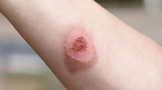 Reasons Why Scab May Fall Off Prematurely