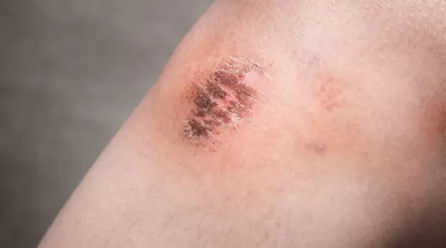Ways To Avoid Scabs Being Ripped Off Accidentally